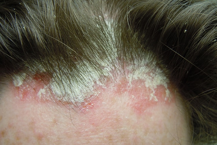 bệnh nấm da đầu là gì?